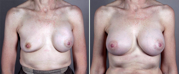 Removal & Replacement of Implants Patient 4