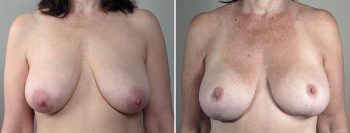 Breast Lift (Vertical Mastopexy Only) Patient 5