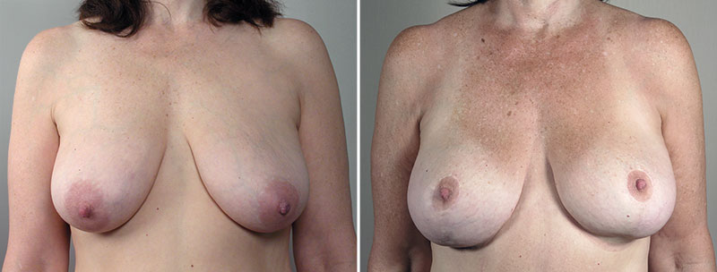 Breast Lift (Vertical Mastopexy Only) Patient 5