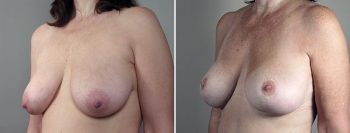 Breast Lift (Vertical Mastopexy Only) Patient 5