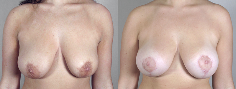 Breast Lift with Implants Patient 11