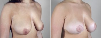 Breast Lift with Implants Patient 11