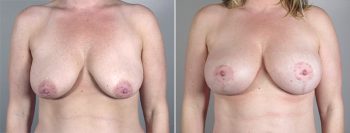 Breast Lift with Implants Patient 10