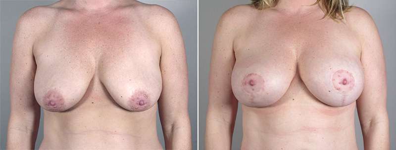 Breast Lift with Implants Patient 10