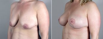 Breast Lift with Implants Patient 10