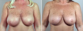 Breast Lift (Vertical Mastopexy Only) Patient 4