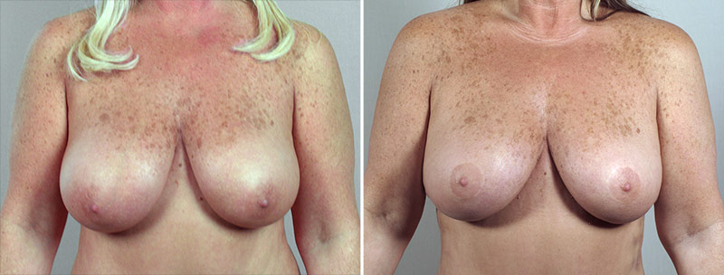 Breast Lift (Vertical Mastopexy Only) Patient 4