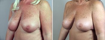 Breast Lift (Vertical Mastopexy Only) Patient 4