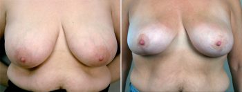 Breast Lift (Vertical Mastopexy Only) Patient 8