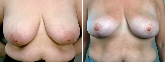 Breast Lift (Vertical Mastopexy Only) Patient 8