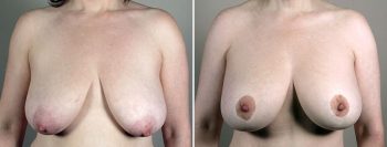 Breast Lift with Implants Patient 19
