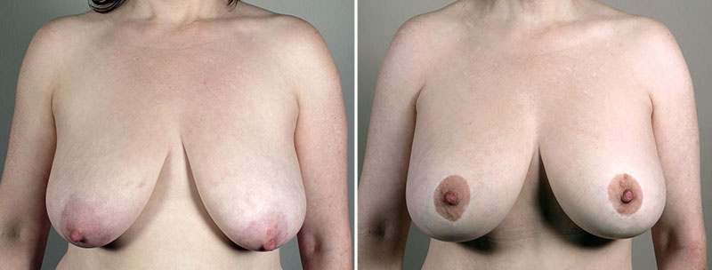 Breast Lift with Implants Patient 19