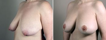 Breast Lift with Implants Patient 19
