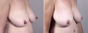 Nipple Reduction Patient 7