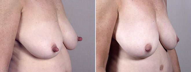 Nipple Reduction Patient 7