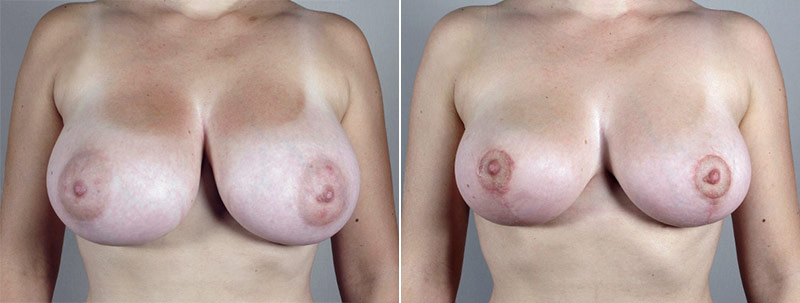 Breast Reduction Patient 6