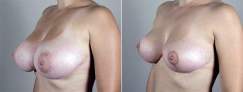 Breast Reduction Patient 6