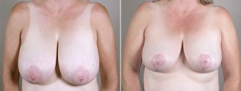 Breast Reduction Patient 21