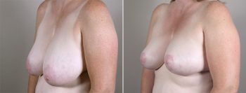 Breast Reduction Patient 21