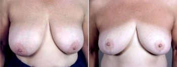 Breast Reduction Patient 19