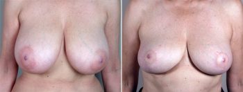 Breast Reduction Patient 12