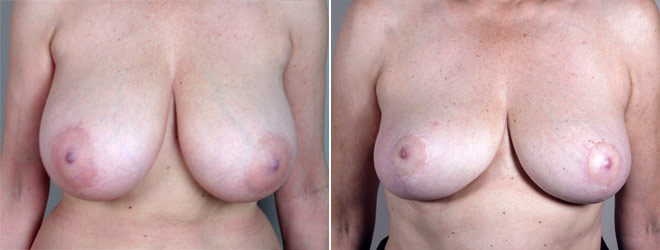 Breast Reduction Patient 12