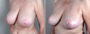 Breast Reduction Patient 12