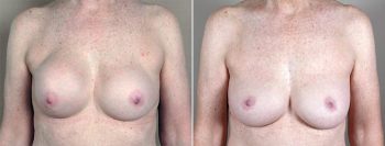 Removal & Replacement of Implants Patient 7