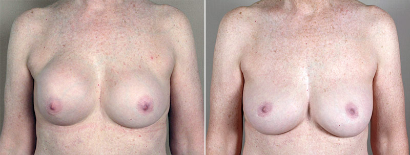 Removal & Replacement of Implants Patient 7