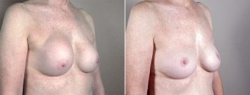 Removal & Replacement of Implants Patient 7