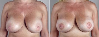 Removal & Replacement of Implants Patient 5