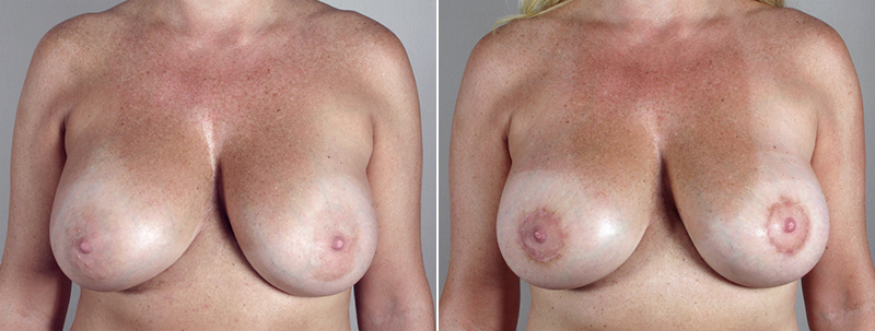 Removal & Replacement of Implants Patient 5