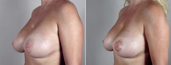 Removal & Replacement of Implants Patient 5