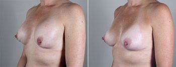 Removal & Replacement of Implants Patient 9