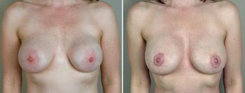 Removal & Replacement of Implants Patient 1