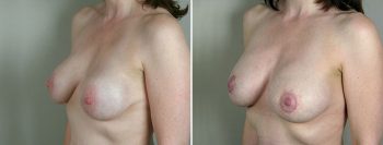 Removal & Replacement of Implants Patient 1