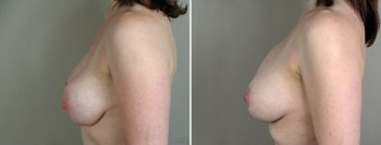 Removal & Replacement of Implants Patient 1