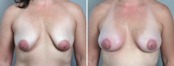 Breast Lift with Implants Patient 15