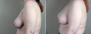 Breast Lift with Implants Patient 17 (Correction of Asymmetry)