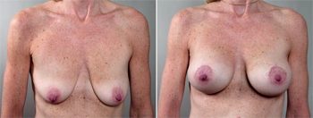 Breast Lift with Implants Patient 3