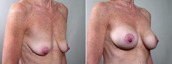 Breast Lift with Implants Patient 3