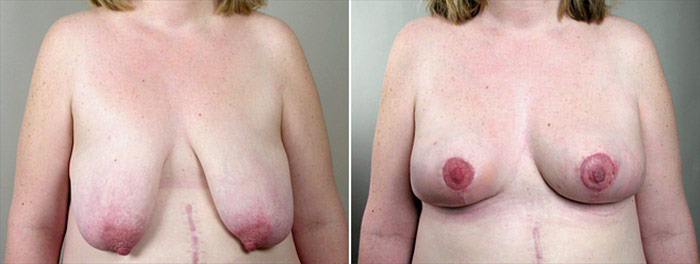 Breast Lift (Vertical Mastopexy Only) Patient 7