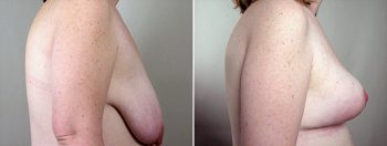 Breast Lift (Vertical Mastopexy Only) Patient 7