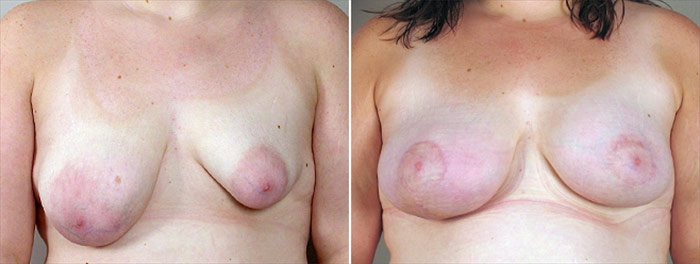 Breast Lift with Implants Patient 16 (Correction of Breast Asymmetry)