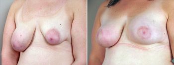 Breast Lift with Implants Patient 16 (Correction of Breast Asymmetry)