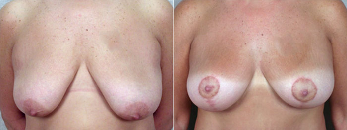 Breast Lift with Implants Patient 4