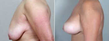 Breast Lift with Implants Patient 4