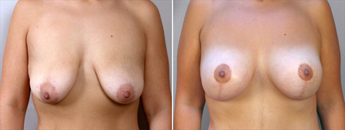 Breast Lift with Implants Patient 5