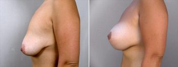 Breast Lift with Implants Patient 5