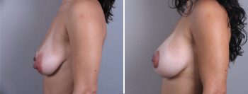 Breast Lift with Implants Patient 7